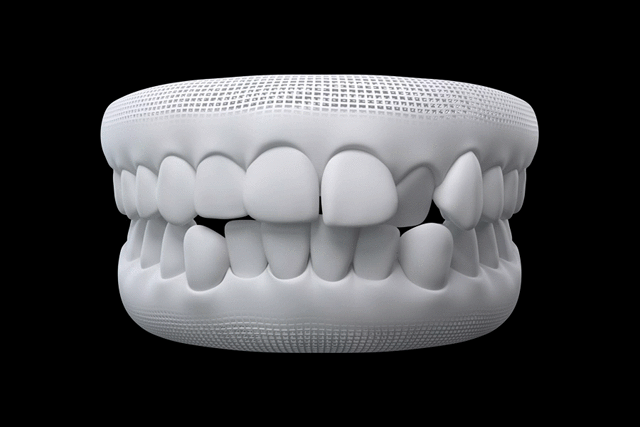 Invisalign treatable cases — teeth alignment animation showing correction