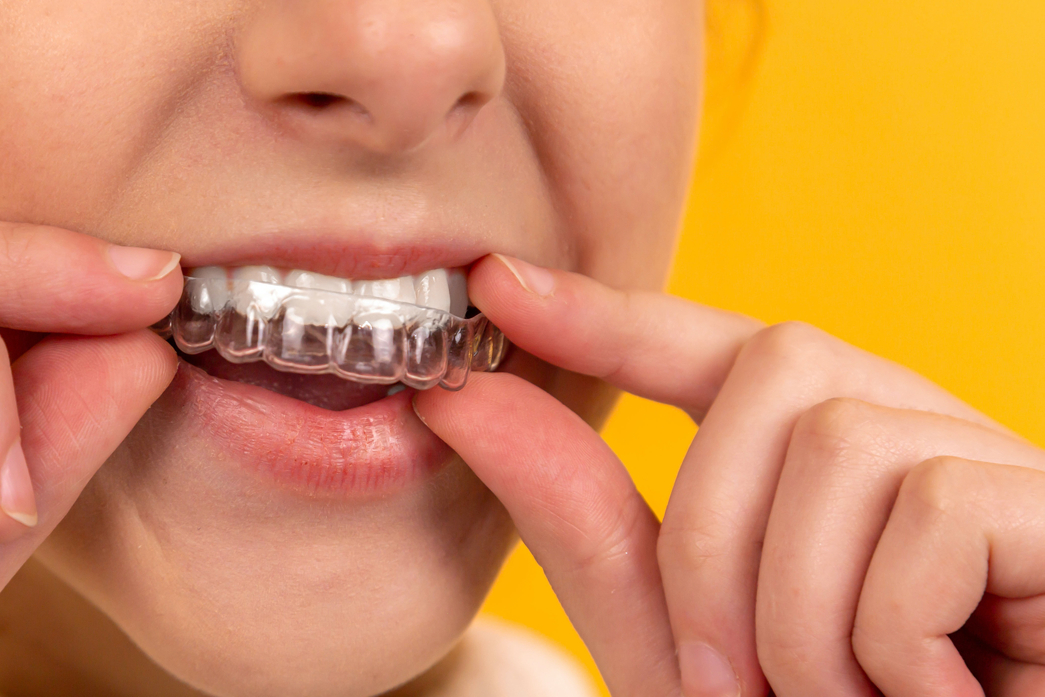 Invisalign treatment at Dental Excellence México — clear aligners